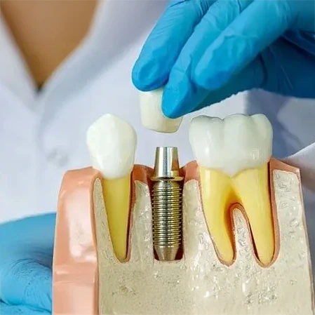 Advanced Dental Implants